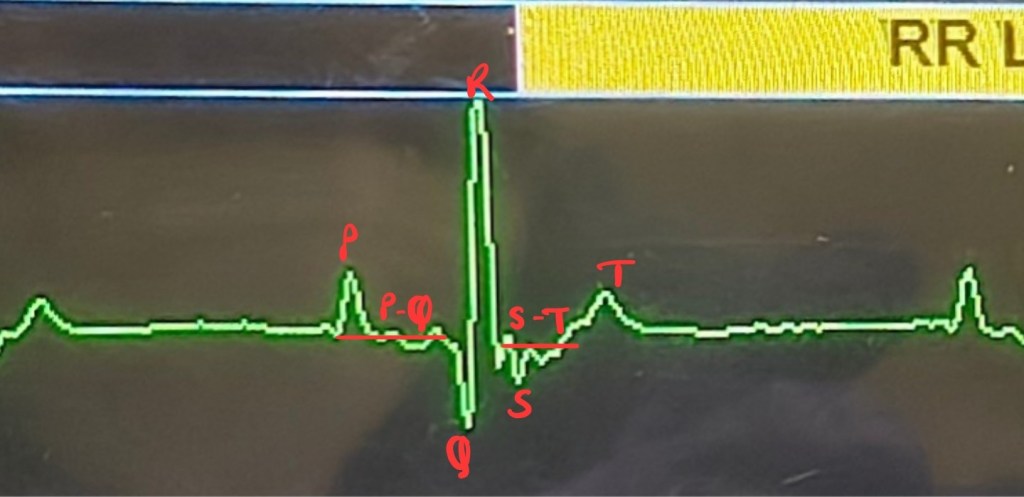 Normal ECG explained